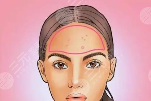 额头长痘