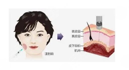 四川华西医院注射瘦脸费用是