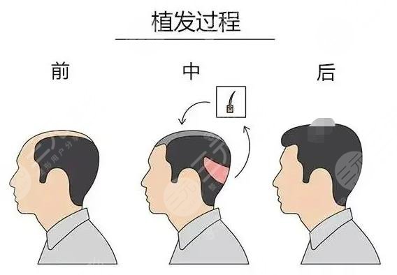缓解脱发小妙招(民间偏方)