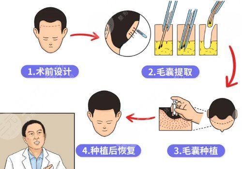 头发种植多少钱一个毛囊?