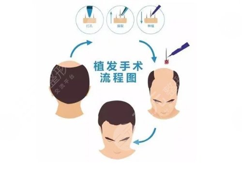 头发种植多少钱一个毛囊?