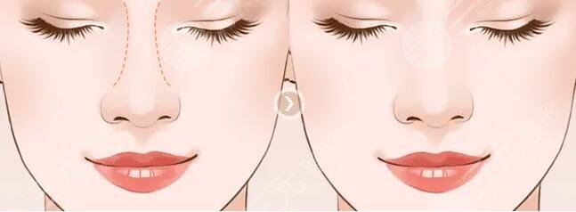 整容鼻子可以保持一辈子吗？