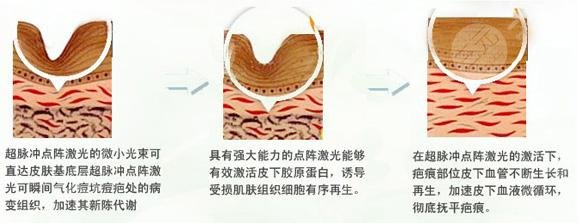 青春期如何祛痘?