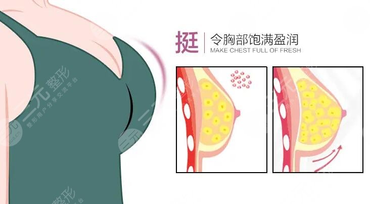 汉中3201医院美容科胸部手术案例