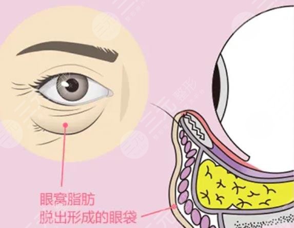 眼袋