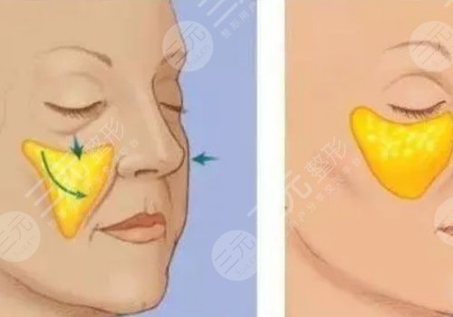 自体脂肪丰苹果肌果好吗?