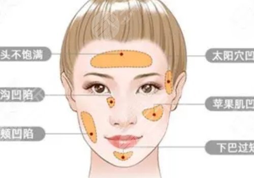自体脂肪丰苹果肌果好吗?