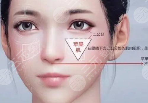 自体脂肪丰苹果肌果好吗?