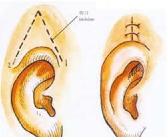全耳再造手术适合哪些人?