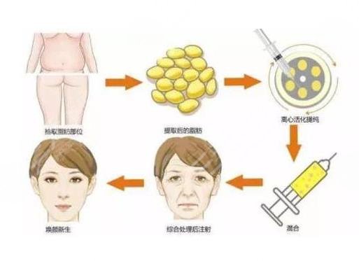 去鼻唇自体脂肪填充和热玛吉哪个好?