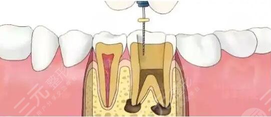 根管缓解后悔一辈子是真的吗？为什么会后悔？根管缓解果可以维持多久？