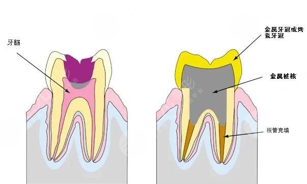 根管缓解持时间是多久？