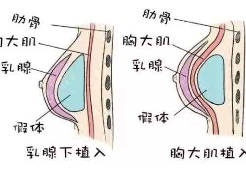 假体隆胸手感和真的有没有区别?