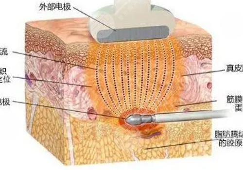 镭射溶脂和激光溶脂的优势