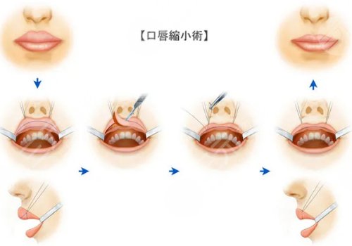 厚唇变薄手术多少钱？