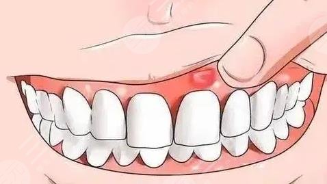 牙龈肿痛有脓包怎么办?