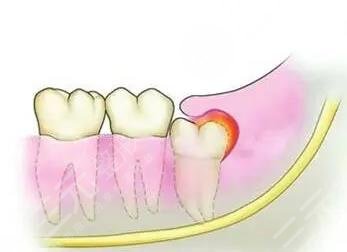 牙龈肿痛有脓包怎么办?