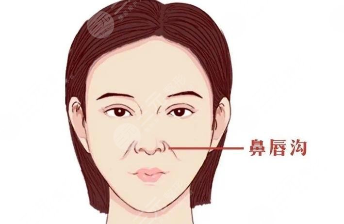 如何去鼻唇沟?