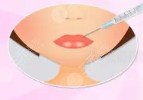 厚嘴唇怎么变薄？