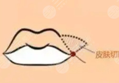 厚嘴唇怎么变薄？