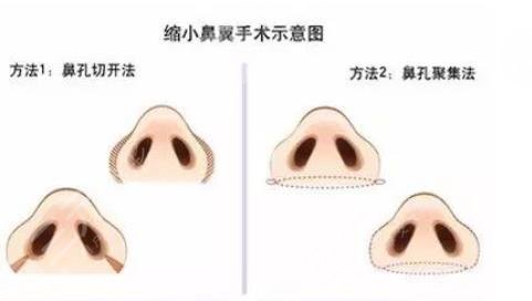 鼻翼整形