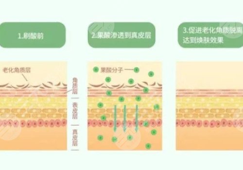 果酸美白果好吗?