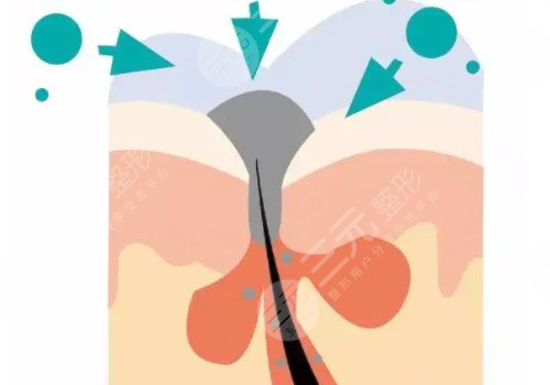 果酸美白果好吗?