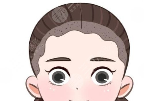 发际线移植能保持多久？