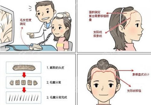 发际线移植能保持多久？