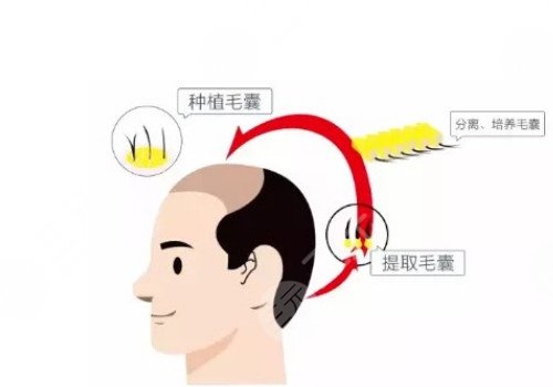 发际线移植能保持多久？