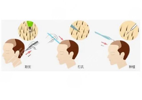 发际线移植能保持多久？