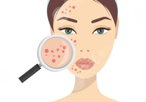 脸上长痘印如何消除?