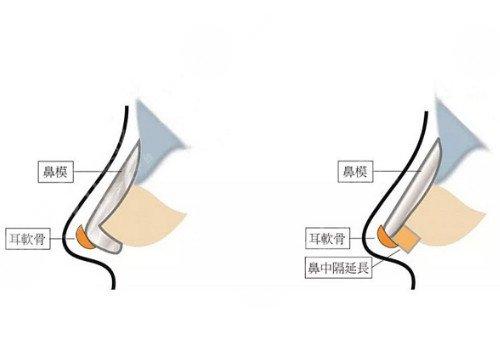自体软骨隆鼻多少钱？