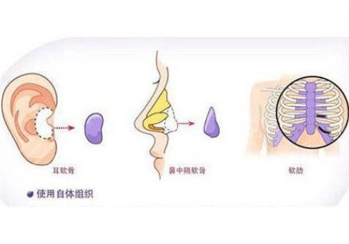 自体软骨隆鼻多少钱？