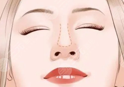 自体软骨隆鼻多少钱？