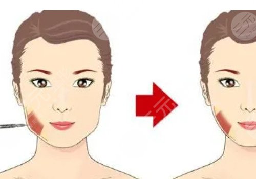 咬肌发达怎么瘦下来?