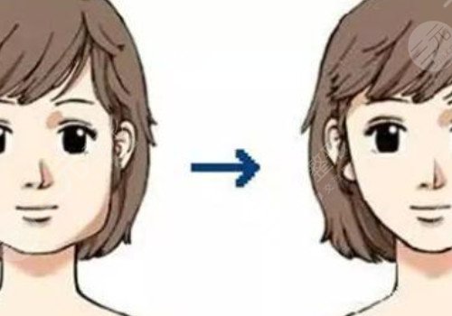 咬肌发达怎么瘦下来?