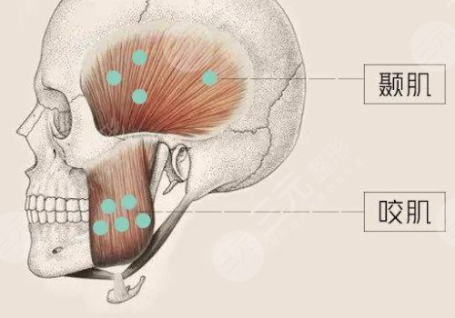 咬肌发达怎么瘦下来?