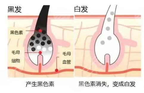 长白头发了是什么原因导致的?
