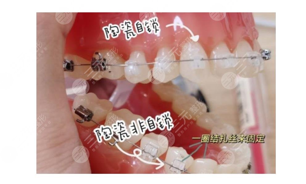 深圳同步齿科牙齿矫正价格表更新