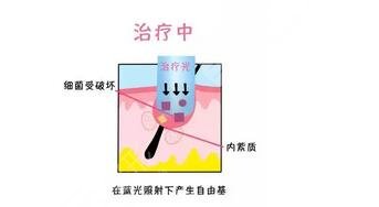红光缓解痤疮多久一次?