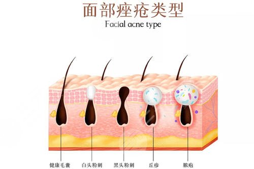 红光缓解痤疮多久一次?