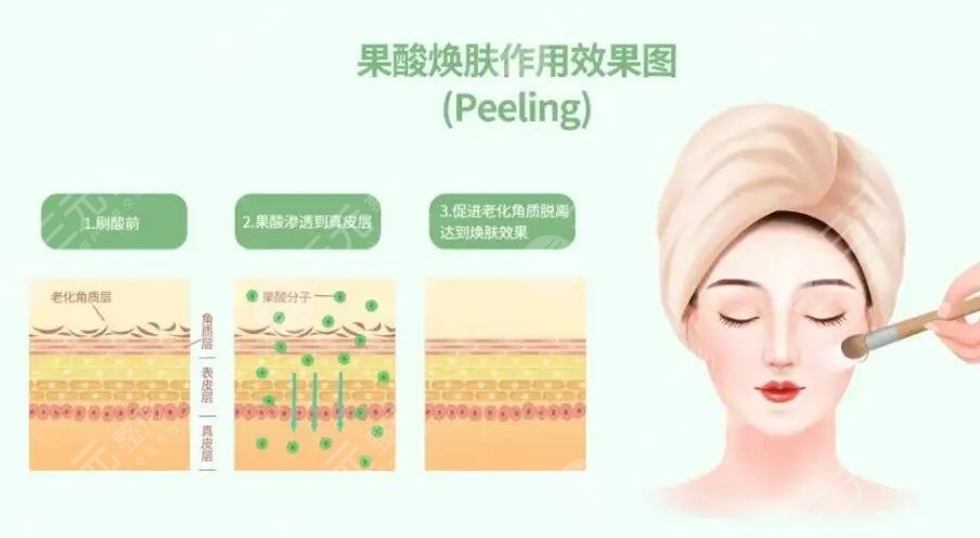 果酸换肤