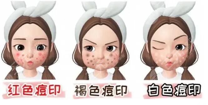 激光祛痘印痘坑多少钱?