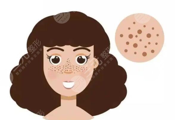 激光去痘坑要做几次?