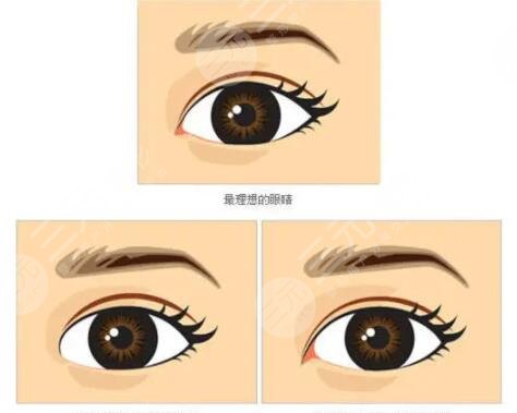 开眼角手术价格