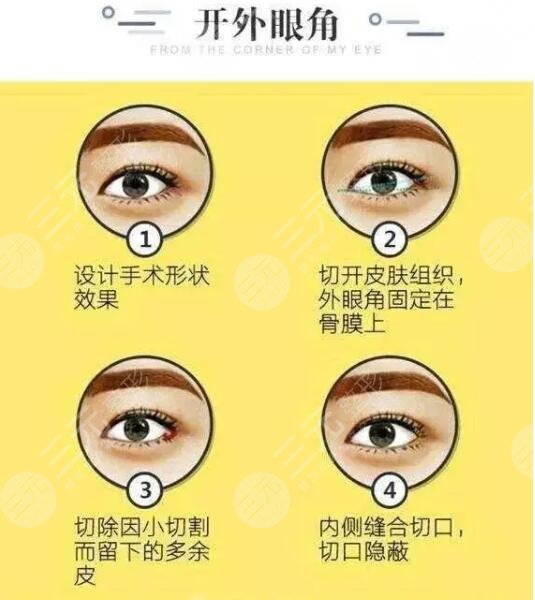 开眼角手术注意事项