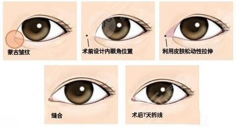 开眼角手术适合人群