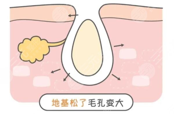 怎么收缩面部毛孔有又快速?文中3中方法你得学起来!如何预防是关键!