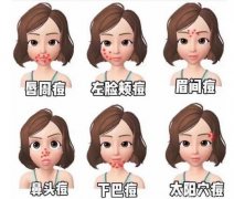 脸上长痘痘的位置代表什么？图文详解分享，5种痘解读！